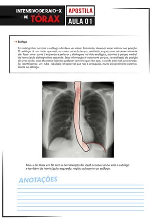 Esôfago
Em radiografias normais o esôfago não deve ser visível. Entretanto, devemos saber estimar sua posição.
O esôfago é um tubo que está, na maior parte do tempo, colabado, e que passa retroesternalmente
até fazer uma curva à esquerda e perfurar o diafragma no hiato esofágico, próximo à porcao medial
da hemicúpula diafragmática esquerda. Essa informação é importante porque, na avaliação da posição
de uma sonda, caso ela esteja fazendo qualquer caminho que não esse, a sonda está mal posicionada.
Se identificamos um tubo lobulado retroesternal que não é a traqueia, muito provavelmente estamos
diante do esôfago.
ANOTAÇÕES
Raio-x de tórax em PA com a demarcação do local provável onde está o esôfago
e também da hemicúpula esquerda, região adjacente ao esôfago.
INTENSIVO DE RAIO-X
DE
aula 01
 