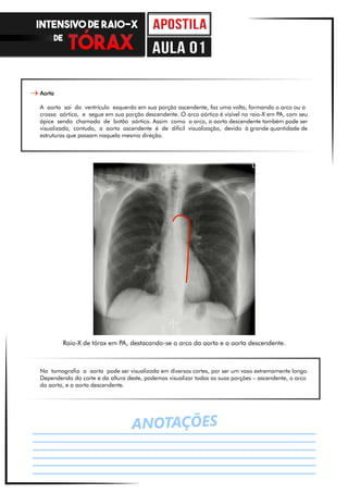 Aorta
A aorta sai do ventrículo esquerdo em sua porção ascendente, faz uma volta, formando o arco ou a
crossa aórtica, e segue em sua porção descendente. O arco aórtico é visível no raio-X em PA, com seu
ápice sendo chamado de botão aórtico. Assim como o arco, a aorta descendente também pode ser
visualizada, contudo, a aorta ascendente é de difícil visualização, devido à grande quantidade de
estruturas que passam naquela mesma direção.
Na tomografia a aorta pode ser visualizada em diversos cortes, por ser um vaso extremamente longo.
Dependendo do corte e da altura deste, podemos visualizar todas as suas porções – ascendente, o arco
da aorta, e a aorta descendente.
Raio-X de tórax em PA, destacando-se o arco da aorta e a aorta descendente.
ANOTAÇÕES
INTENSIVO DE RAIO-X
DE
aula 01
 