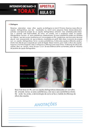Diafragma
Devemos sistematizar nosso olhar quanto ao diafragma no raio-X. Primeiro, focamos nosso olhar às
cúpulas diafragmáticas, que são visualizadas no raio-X como pequenas faixas densas abaixo dos
pulmões e do ápice do coração. Se as cúpulas diafragmáticas estiverem mais achatadas pode indicar
que o paciente está hiperinsuflado. Ao entrar em contato com o arcabouço costal, as cúpulas
diafragmáticas formam os seios costofrênicos, bilateralmente. Os seios costofrênicos podem ser divididos
em laterais, que são os que visualizamos em uma projeção em PA, e posteriores, que acumulam derrame
pleural mais precocemente do que os laterais, visualizados em perfil. Além disso, o encontro do coração
com as cúpulas diafragmáticas forma os seios cardiofrênicos. A altura das cúpulas é diferente, sendo a
direita mais alta do que a esquerda por conta do fígado. Dessa maneira, para medir a altura das cúpulas,
traçamos uma linha tangente a elas e verificamos a diferença entre essas linhas. A diferença da altura das
cúpulas deve ser sempre menor do que 1,5 cm. Se essa distância estiver aumentada, pode ser indicativo
de paralisia de cúpula diafragmática.
ANOTAÇÕES
Raio-X de tórax em PA, com as cúpulas diafragmáticas destacadas em vermelho.
De amarelo temos os seios costofrênicos, e de roxo o seio cardiofrênico direito.
De verde há, ainda, a demonstração de como se faz a medida da diferença de
altura das cúpulas.
INTENSIVO DE RAIO-X
DE
aula 01
 
