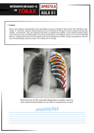 ANOTAÇÕES
Costelas
São os ossos oblíquos representados como opacidades curvas que “abraçam” todo o tórax. Para identificar cada
costela é importante seguí-las, descrevendo seu arco e verificando se há alguma fratura, porque as bordas das
costelas, normalmente, são bem retilíneas. Para fazer a contagem das costelas, o mais indicado é fazê-lo pelos
arcos anteriores, pois sua diferenciação é mais fácil, sendo eles os mais oblíquos. Assim, em um raio-X adequado
deve-se visualizar pelo menos 6 arcos anteriores acima do diafragma no adulto. Já para os posteriores, que são
mais horizontalizados, devemos contar 10 no adulto e 8 na criança.
Raio-X de tórax em PA, onde estão destacadas as costelas, sendo os
arcos anteriores demarcados em vermelho e os posteriores em azul.
INTENSIVO DE RAIO-X
DE
aula 01
 