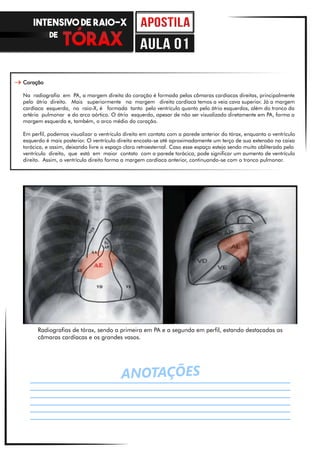 ANOTAÇÕES
Coração
Na radiografia em PA, a margem direita do coração é formada pelas câmaras cardíacas direitas, principalmente
pelo átrio direito. Mais superiormente na margem direita cardíaca temos a veia cava superior. Já a margem
cardíaca esquerda, no raio-X, é formada tanto pelo ventrículo quanto pelo átrio esquerdos, além do tronco da
artéria pulmonar e do arco aórtico. O átrio esquerdo, apesar de não ser visualizado diretamente em PA, forma a
margem esquerda e, também, o arco médio do coração.
Em perfil, podemos visualizar o ventrículo direito em contato com a parede anterior do tórax, enquanto o ventrículo
esquerdo é mais posterior. O ventrículo direito encosta-se até aproximadamente um terço de sua extensão na caixa
torácica, e assim, deixando livre o espaço claro retroesternal. Caso esse espaço esteja sendo muito obliterado pelo
ventrículo direito, que está em maior contato com a parede torácica, pode significar um aumento de ventrículo
direito. Assim, o ventrículo direito forma a margem cardíaca anterior, continuando-se com o tronco pulmonar.
Radiografias de tórax, sendo a primeira em PA e a segunda em perfil, estando destacadas as
câmaras cardíacas e os grandes vasos.
INTENSIVO DE RAIO-X
DE
aula 01
 