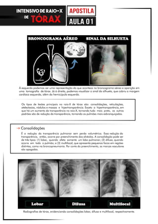 Os tipos de lesões principais no raio-X de tórax são: consolidações, reticulações,
atelectasias, nódulos e massas e hipertransparência. Exceto a hipertransparência, em
que há um aumento da transparência no raio-X, tornando tudo mais preto, os outros
padrões são de redução da transparência, tornando os pulmões mais esbranquiçados.
É a redução da transparência pulmonar sem perda volumétrica. Essa redução da
transparência, então, ocorre por preenchimento dos alvéolos. A consolidação pode ser
de três tipos: (1) lobar, quando afeta somente um lobo pulmonar; (2) difusa, quando
ocorre em todo o pulmão; e (3) multifocal, que apresenta pequenos focos em regiões
distintas, como na broncopneumonia. Por conta do preenchimento, as marcas vasculares
são apagadas.
À esquerda podemos ver uma representação do que acontece no broncograma aéreo e aparição em
uma tomografia de tórax. Já à direita, podemos visualizar o sinal da silhueta, que cobriu a margem
cardíaca esquerda, além da hemicúpula esquerda.
Radiografias de tórax, evidenciando consolidações lobar, difusa e multifocal, respectivamente.
Consolidações
INTENSIVO DE RAIO-X
DE
aula 01
 