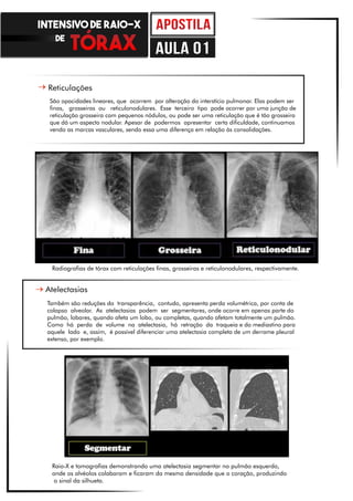 Não Caia em Armadilhas
Reticulações
São opacidades lineares, que ocorrem por alteração do interstício pulmonar. Elas podem ser
finas, grosseiras ou reticulonodulares. Esse terceiro tipo pode ocorrer por uma junção de
reticulação grosseira com pequenos nódulos, ou pode ser uma reticulação que é tão grosseira
que dá um aspecto nodular. Apesar de podermos apresentar certa dificuldade, continuamos
vendo as marcas vasculares, sendo essa uma diferença em relação às consolidações.
Atelectasias
Também são reduções da transparência, contudo, apresenta perda volumétrica, por conta de
colapso alveolar. As atelectasias podem ser segmentares, onde ocorre em apenas parte do
pulmão, lobares, quando afeta um lobo, ou completas, quando afetam totalmente um pulmão.
Como há perda de volume na atelectasia, há retração da traqueia e do mediastino para
aquele lado e, assim, é possível diferenciar uma atelectasia completa de um derrame pleural
extenso, por exemplo.
Radiografias de tórax com reticulações finas, grosseiras e reticulonodulares, respectivamente.
Raio-X e tomografias demonstrando uma atelectasia segmentar no pulmão esquerdo,
onde os alvéolos colabaram e ficaram da mesma densidade que o coração, produzindo
o sinal da silhueta.
INTENSIVO DE RAIO-X
DE
aula 01
 