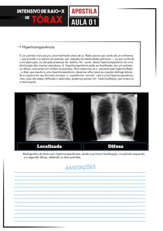ANOTAÇÕES
Hipertransparência
É um pulmão mais escuro, anormalmente cheio de ar. Pode ocorrer por conta de um enfisema
– que prende o ar dentro do pulmão, por redução da elasticidade pulmonar –, ou por conta de
uma obstrução, ou até pela presença de bolhas. Por conta dessa hipertransparência há uma
diminuição das marcas vasculares. A hipertransparência pode ser localizada, em um pulmão,
ou difusa, ocorrendo em ambos os pulmões. Para sabermos se o paciente está hiperinsuflado
, e dizer que aquilo é uma hipertransparência, devemos olhar para as cúpulas diafragmáticas.
Se a cúpula tiver seu formato convexo e cupuliforme normal, não é uma hipertransparência,
mas, caso ela esteja retificada e aplanada, podemos pensar em hiperinsuflação, que empurra
a hemicúpula.
Radiografias de tórax com hipertransparências, sendo a primeira localização, no pulmão esquerdo,
e a segunda difusa, afetando os dois pulmões.
INTENSIVO DE RAIO-X
DE
aula 01
 