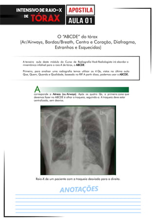 ANOTAÇÕES
O “ABCDE” do tórax
(Ar/Airways, Bordas/Breath, Centro e Coração, Diafragma,
Estranhos e Esquecidas)
A terceira aula deste módulo do Curso de Radiografia Você Radiologista irá abordar o
mnemônico infalível para o raio-X de tórax, o ABCDE.
Primeiro, para analisar uma radiografia temos utilizar os 4 Qs, vistos na última aula:
Que, Quem, Quando e Qualidade, baseado no RIP. A partir disso, podemos usar o ABCDE.
Raio-X de um paciente com a traqueia desviada para a direita.
corresponde a Aéreas (ou Airways). Após os quatro Qs, a primeira coisa que
devemos fazer no ABCDE é olhar a traqueia, seguindo-a. A traqueia deve estar
centralizada, sem desvios.
A
INTENSIVO DE RAIO-X
DE
aula 01
 