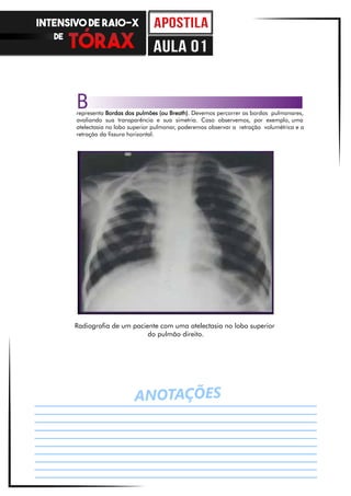 ANOTAÇÕES
Radiografia de um paciente com uma atelectasia no lobo superior
do pulmão direito.
representa Bordas dos pulmões (ou Breath). Devemos percorrer as bordas pulmonares,
avaliando sua transparência e sua simetria. Caso observemos, por exemplo, uma
atelectasia no lobo superior pulmonar, poderemos observar a retração volumétrica e a
retração da fissura horizontal.
B
INTENSIVO DE RAIO-X
DE
aula 01
 