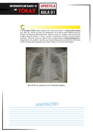 ANOTAÇÕES
Raio-X de um paciente com linfonodomegalia.
é de Coração e Centro. Após avaliar A e B, devemos calcular o índice cárdio-torácico,
que deve ser menor do que 0,5 (lembre-se, o IC é igual a maior distância entre as
margens cardíacas dividido pela maior distância entre as paredes internas do tórax).
A seguir, devemos avaliar o centro, ou seja, o mediastino, os hilos e os vasos da base
pulmonar. Devemos procurar, dessa forma, espessamento da faixa paratraqueal ou
alargamento do pedículo vascular, que indicam alargamento mediastinal. Além disso,
o hilo não deve estar espessado, pois pode configurar uma linfonodomegalia.
C
INTENSIVO DE RAIO-X
DE
aula 01
 