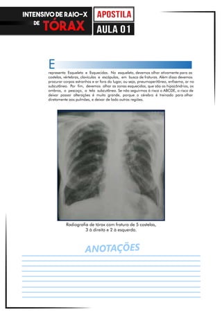 ANOTAÇÕES
representa Esqueleto e Esquecidas. No esqueleto, devemos olhar ativamente para as
costelas, vértebras, clavículas e escápulas, em busca de fraturas. Além disso devemos
procurar corpos estranhos e ar fora do lugar, ou seja, pneumoperitôneo, enfisema, ar no
subcutâneo. Por fim, devemos olhar as zonas esquecidas, que são os hipocôndrios, os
ombros, o pescoço, a tela subcutânea. Se não seguirmos à risca o ABCDE, o risco de
deixar passar alterações é muito grande, porque o cérebro é treinado para olhar
diretamente aos pulmões, e deixar de lado outras regiões.
E
Radiografia de tórax com fratura de 5 costelas,
3 à direita e 2 à esquerda.
INTENSIVO DE RAIO-X
DE
aula 01
 