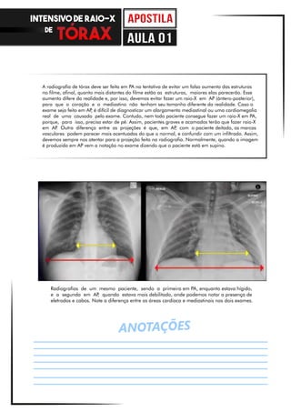 Radiografias de um mesmo paciente, sendo a primeira em PA, enquanto estava hígido,
e a segunda em AP, quando estava mais debilitado, onde podemos notar a presença de
eletrodos e cabos. Note a diferença entre as áreas cardíaca e mediastinais nos dois exames.
ANOTAÇÕES
A radiografia de tórax deve ser feita em PA na tentativa de evitar um falso aumento das estruturas
no filme, afinal, quanto mais distantes do filme estão as estruturas, maiores elas parecerão. Esse
aumento difere da realidade e, por isso, devemos evitar fazer um raio-X em AP (ántero-posterior),
para que o coração e o mediastino não tenham seu tamanho diferente da realidade. Caso o
exame seja feito em AP, é difícil de diagnosticar um alargamento mediastinal ou uma cardiomegalia
real de uma causada pelo exame. Contudo, nem todo paciente consegue fazer um raio-X em PA,
porque, para isso, precisa estar de pé. Assim, pacientes graves e acamados terão que fazer raio-X
em AP. Outra diferença entre as projeções é que, em AP, com o paciente deitado, as marcas
vasculares podem parecer mais acentuadas do que o normal, e confundir com um infiltrado. Assim,
devemos sempre nos atentar para a projeção feita na radiografia. Normalmente, quando a imagem
é produzida em AP vem a notação no exame dizendo que o paciente está em supino.
INTENSIVO DE RAIO-X
DE
aula 01
 