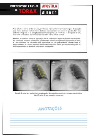 ANOTAÇÕES
Para calcular o índice cárdio-torácico, dividimos a maior distancia entre as margens do coração
pela maior distancia na face interna do tórax. Esse valor deve ser menor do que 0,5. Para isso,
podemos imaginar se o coração cabe dentro de apenas um hemitórax. Se a resposta for sim,
essa conta com certeza dará menor do que 0,5 e a área estará normal.
Ademais, outra razão pela qual a projeção em PA é necessária é para a retirada das escápulas
do campo da imagem. Desse modo, podemos ter uma visualização mais apropriada do tórax,
e não confundir as escápulas com opacidades ou um pneumotórax. Quanto mais as
escápulas estão no campo, com mais facilidade conseguimos definir que aquela radiografia foi
feita em supino ou foi feita com uma técnica inadequada.
Raios-X de tórax em supino, com as escapulas demarcadas na primeira imagem para melhor
identificação de sua presença no campo.
INTENSIVO DE RAIO-X
DE
aula 01
 