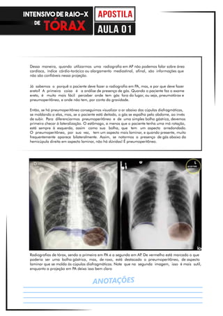 ANOTAÇÕES
Dessa maneira, quando utilizarmos uma radiografia em AP não podemos falar sobre área
cardíaca, índice cárdio-torácico ou alargamento mediastinal, afinal, são informações que
não são confiáveis nessa projeção.
Já sabemos o porquê o paciente deve fazer a radiografia em PA, mas, e por que deve fazer
ereto? A primeira coisa é a análise de presença de gás. Quando o paciente faz o exame
ereto, é muito mais fácil perceber onde tem gás fora do lugar, ou seja, pneumotórax e
pneumoperitôneo, e onde não tem, por conta da gravidade.
Então, se há pneumoperitôneo conseguimos visualizar o ar abaixo das cúpulas diafragmáticas,
se moldando a elas, mas, se o paciente está deitado, o gás se espalha pelo abdome, ao invés
de subir. Para diferenciarmos pneumoperitôneo e de uma simples bolha gástrica, devemos
primeiro checar à lateralização. O estômago, a menos que o paciente tenha uma má rotação,
está sempre à esquerda, assim como sua bolha, que tem um aspecto arredondado.
O pneumoperitôneo, por sua vez, tem um aspecto mais laminar, e quando presente, muito
frequentemente aparece bilateralmente. Assim, se notarmos a presença de gás abaixo da
hemicúpula direita em aspecto laminar, não há dúvidas! É pneumoperitôneo.
Radiografias de tórax, sendo a primeira em PA e a segunda em AP. De vermelho está marcado o que
poderia ser uma bolha gástrica, mas, de roxo, está destacado o pneumoperitôneo, de aspecto
laminar que se molda às cúpulas diafragmáticas. Note que na segunda imagem, isso é mais sutil,
enquanto a projeção em PA deixa isso bem claro
INTENSIVO DE RAIO-X
DE
aula 01
 