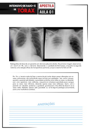 ANOTAÇÕES
Por fim, a terceira razão de fazer o exame de pé é evitar deixar passar alterações com os
vasos pulmonares, não confundindo vasos normais com patologias. Isso ocorre porque,
quando o paciente está deitado, a gravidade se distribui entre todos os vasos, os deixando
com uma aparência mais calibrosa, enquanto em ortostase a gravidade puxa o sangue
para os vasos mais inferiores, deixando apenas esses mais calibrosos. Assim, com o
paciente em decúbito perdemos o gradiente gravitacional e fica difícil de discernir se os
vasos estão dilatados apenas pela gravidade ou se há alguma patologia concomitante,
como uma insuficiência cardíaca.
Radiografias de tórax de um paciente com derrame pleural à direita. Na primeira imagem observamos
um raio-X em PA, com o derrame descrevendo a parábola de Daimoiseau, enquanto na segunda
notamos uma redução difusa da transparência pulmonar, já que o exame foi feito em AP.
INTENSIVO DE RAIO-X
DE
aula 01
 