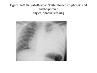 Figure: Left Pleural effusion: Obliterated costo-phrenic and
cardio-phrenic
angles, opaque left lung
 
