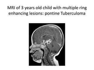 MRI of 3 years old child with multiple ring
enhancing lesions: pontine Tuberculoma
 