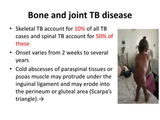 Bone and joint TB disease
• Skeletal TB account for 10% of all TB
cases and spinal TB account for 50% of
these
• Onset varies from 2 weeks to several
years
• Cold abscesses of paraspinal tissues or
psoas muscle may protrude under the
inguinal ligament and may erode into
the perineum or gluteal area (Scarpa’s
triangle).→
 