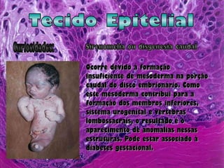 Tecido Epitelial Curiosidades: Sirenomelia ou disgenesia caudal  Ocorre devido à formação insuficiente de mesoderma na porção caudal do disco embrionário. Como este mesoderma contribui para a formação dos membros inferiores, sistema urogenital e vértebras lombossacrais, o resultado é o aparecimento de anomalias nessas estruturas. Pode estar associado à diabetes gestacional.  