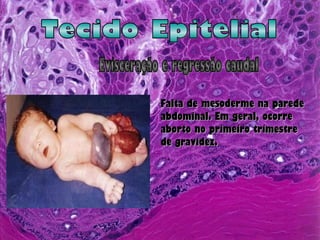 Tecido Epitelial Evisceração e regressão caudal Falta de mesoderme na parede abdominal. Em geral, ocorre aborto no primeiro trimestre de gravidez.  