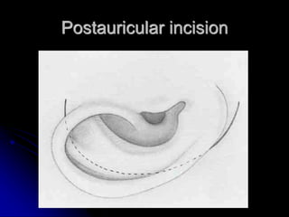 Postauricular Injection TYMPANOPLASTY TYMPANOPLASTY TYMPANOPLASTY TYMPANOPLASTY | PDF
