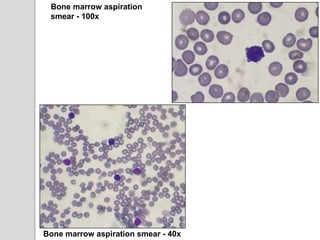 Bone marrow aspiration
smear - 100x
Bone marrow aspiration smear - 40x
 