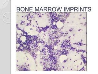 BONE MARROW IMPRINTS
 