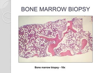 BONE MARROW BIOPSY
Bone marrow biopsy - 10x
 