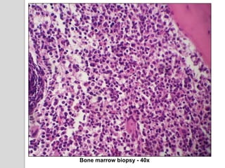 Bone marrow biopsy - 40x
 