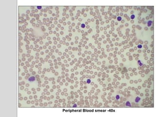Peripheral Blood smear -40x
 