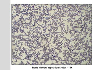 Bone marrow aspiration smear - 10x
 