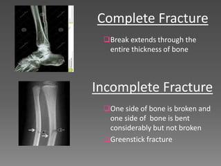 Incomplete Break The Skeletal System | PPTX