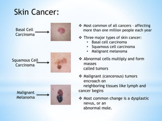  Most common of all cancers – affecting
more than one million people each year
 Three major types of skin cancer:
• Basal cell carcinoma
• Squamous cell carcinoma
• Malignant melanoma
 Abnormal cells multiply and form
masses
called tumors
 Malignant (cancerous) tumors
encroach on
neighboring tissues like lymph and
cancer begins
 Most common change is a dysplastic
nevus, or an
abnormal mole.
Skin Cancer:
Basal Cell
Carcinoma
Squamous Cell
Carcinoma
Malignant
Melanoma
 