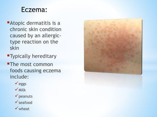 Atopic dermatitis is a
chronic skin condition
caused by an allergic-
type reaction on the
skin
Typically hereditary
The most common
foods causing eczema
include:
eggs
Milk
peanuts
seafood
wheat
Eczema:
 