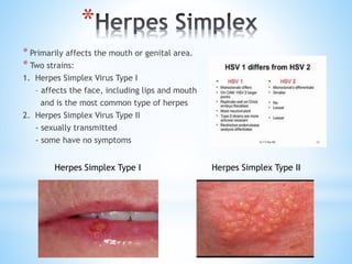 *
* Primarily affects the mouth or genital area.
* Two strains:
1. Herpes Simplex Virus Type I
– affects the face, including lips and mouth
and is the most common type of herpes
2. Herpes Simplex Virus Type II
- sexually transmitted
- some have no symptoms
Herpes Simplex Type I Herpes Simplex Type II
 