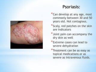 *Can develop at any age, most
commonly between 30 and 50
years old. Not contagious.
*Scaly, red patches on the skin
are indicators
*Joint pain can accompany the
dry skin as well
*Extreme cases can lead to
severe dehydration
*Treatment can be as easy as
topical medications or as
severe as intravenous fluids.
Psoriasis:
 