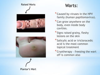 *Caused by viruses in the HPV
family (human papillomavirus).
*Can grow anywhere on the
body, even inside body
cavities.
*Signs raised grainy, fleshy
lesions on the skin
*Salicylic acid or tricloracedic
acid is the most common
topical treatment
*Cryotherapy – freezing the wart
off is common also
Warts:
Plantar’s Wart
Raised Warts
 