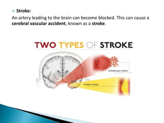  Stroke:
An artery leading to the brain can become blocked. This can cause a
cerebral vascular accident, known as a stroke.
 