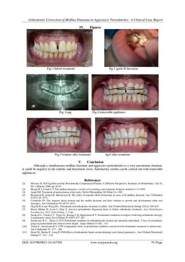 Orthodontic Correction of Midline Diastema in Aggressive Periodontiti…