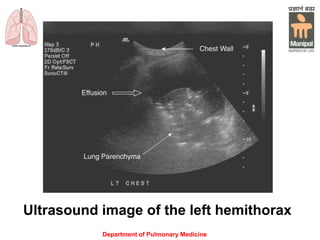 Ultrasound image of the left hemithorax
Department of Pulmonary Medicine
 
