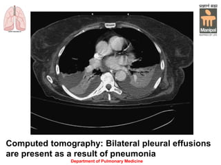 Computed tomography: Bilateral pleural effusions
are present as a result of pneumonia
Department of Pulmonary Medicine
 