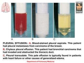 PLEURAL EFFUSION.: A, Blood-stained pleural aspirate. This patient
had pleural metastases from carcinoma of the breast.
B, Chylous pleural effusion. This patient had bronchial carcinoma that
had invaded and obstructed the thoracic duct.
C, Pleural transudate. This pale effusion is typically found in patients
with heart failure or other causes of generalized edema.
Department of Pulmonary Medicine
 