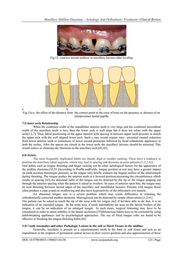 Maxillary Midline Diastema Aetiology And Orthodontic Treatment