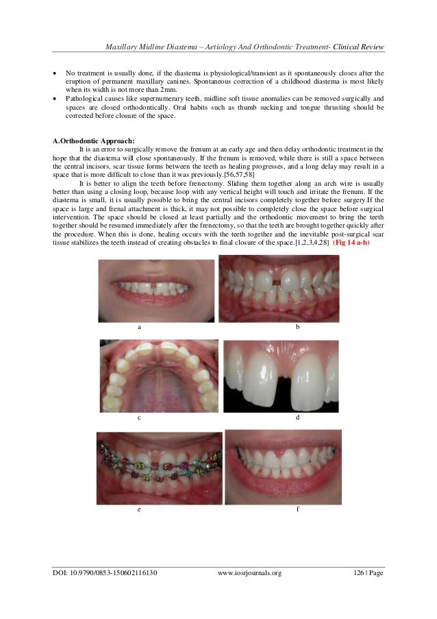 Maxillary Midline Diastema Aetiology And Orthodontic Treatment Cl…