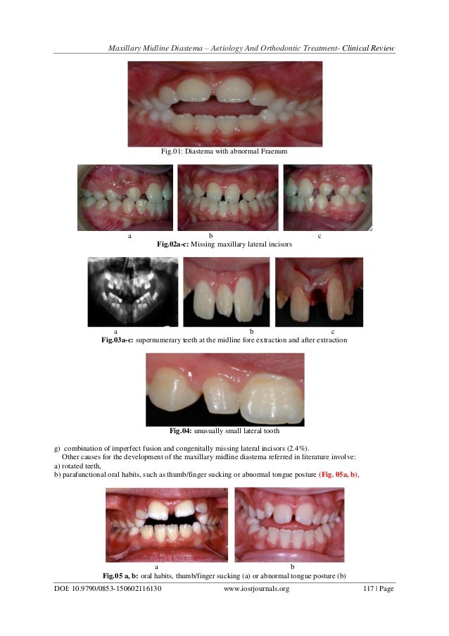 Maxillary Midline Diastema Aetiology And Orthodontic Treatment Cl…
