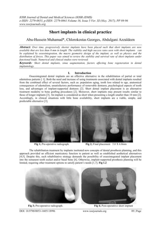 IOSR Journal of Dental and Medical Sciences (IOSR-JDMS)
e-ISSN: 2279-0853, p-ISSN: 2279-0861.Volume 16, Issue 5 Ver. XI (May. 2017), PP 89-96
www.iosrjournals.org
DOI: 10.9790/0853-1605118996 www.iosrjournals.org 89 | Page
Short implants in clinical practice
Abu-Hussein Muhamad*, Chlorokostas Georges, Abdulgani Azzaldeen
Abstract: Over time, progressively shorter implants have been placed such that short implants are now
available that are less than 6 mm in length. The viability and high success rates seen with short implants can
be explained by osseointegration, the macro geometric design of the implant, as well as physics and the
distribution of forces. This paper was aimed to review the stability and survival rate of short implants under
functional loads. Numerical and clinical studies were reviewed.
Keywords: Short dental implants, sinus augmentation, factors affecting bone regeneration in dental
implantology.
I. Introduction
Osseointegrated dental implants are an effective alternative in the rehabilitation of partial or total
edentulous patients [ 1]. Both the need and increase of using treatments associated with dental implants resulted
from the combined effect of several factors, such as: population aging, tooth loss related to age, anatomical
consequences of edentulism, unsatisfactory performance of removable dentures, psychological aspects of tooth
loss, and advantages of implant-supported dentures [2]. Short dental implant placement is an alternative
treatment modality to bone grafting procedures [2]. Moreover, short implants may present results similar to
those of longer implants [3]. An implant is considered as short when presenting a length smaller than 10 mm [2].
Accordingly, in clinical situations with little bone availability, short implants are a viable, simple, and
predictable alternative [3].
Fig 1; Pre-operative radiograph. Fig 2; Final placement 5.0 X 6.0mm
The rehabilitation treatment by implants instituted new concepts of dental prosthesis planning, and this
approach provided an efficient masticatory function to patient as well as established aesthetical alternatives
[4,5]. Despite this, such rehabilitative strategy demands the possibility of osseointegrated implant placement
into the remanent tooth socket and/or basal bone [6]. Otherwise, implant-supported prosthesis planning will be
limited, requiring other treatment options to satisfy patient’s needs [1,7]. Fig 1.2
Fig 3; Pre-operative radiograph. Fig 4; Post-operattive short implant
 