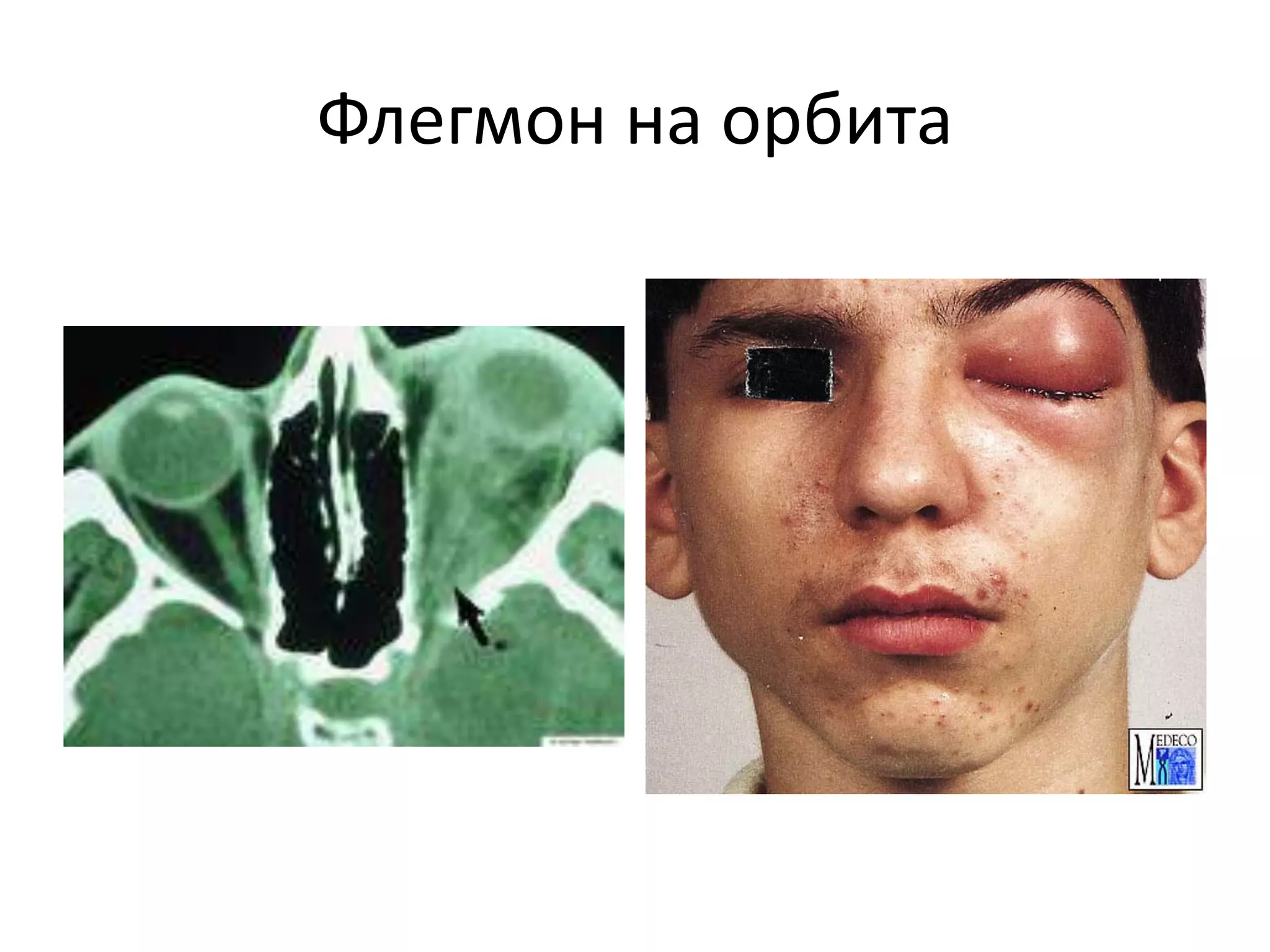 T1 abscessi and phlegmone of the face trif | PPT
