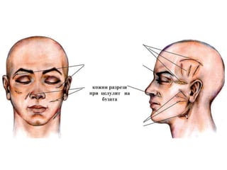 T1 abscessi and phlegmone of the face trif | PPTX