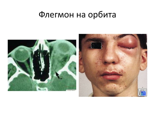T1 abscessi and phlegmone of the face trif | PPT