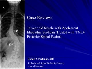 Case Review:

            14 year old female with Adolescent
      42°
            Idiopathic Scoliosis Treated with T3-L4
            Posterior Spinal Fusion

47°



            Robert S Pashman, MD
            Scoliosis and Spinal Deformity Surgery
            www.eSpine.com
 