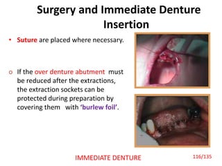 Surgery and Immediate Denture
Insertion
• Suture are placed where necessary.
o If the over denture abutment must
be reduced after the extractions,
the extraction sockets can be
protected during preparation by
covering them with ‘burlew foil’.
IMMEDIATE DENTURE 116/135
 