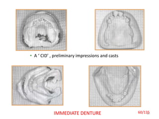 60IMMEDIATE DENTURE
• A ‘ CID’ , preliminary impressions and casts
60/135
 