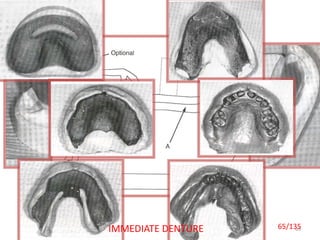 6565/135IMMEDIATE DENTURE
 